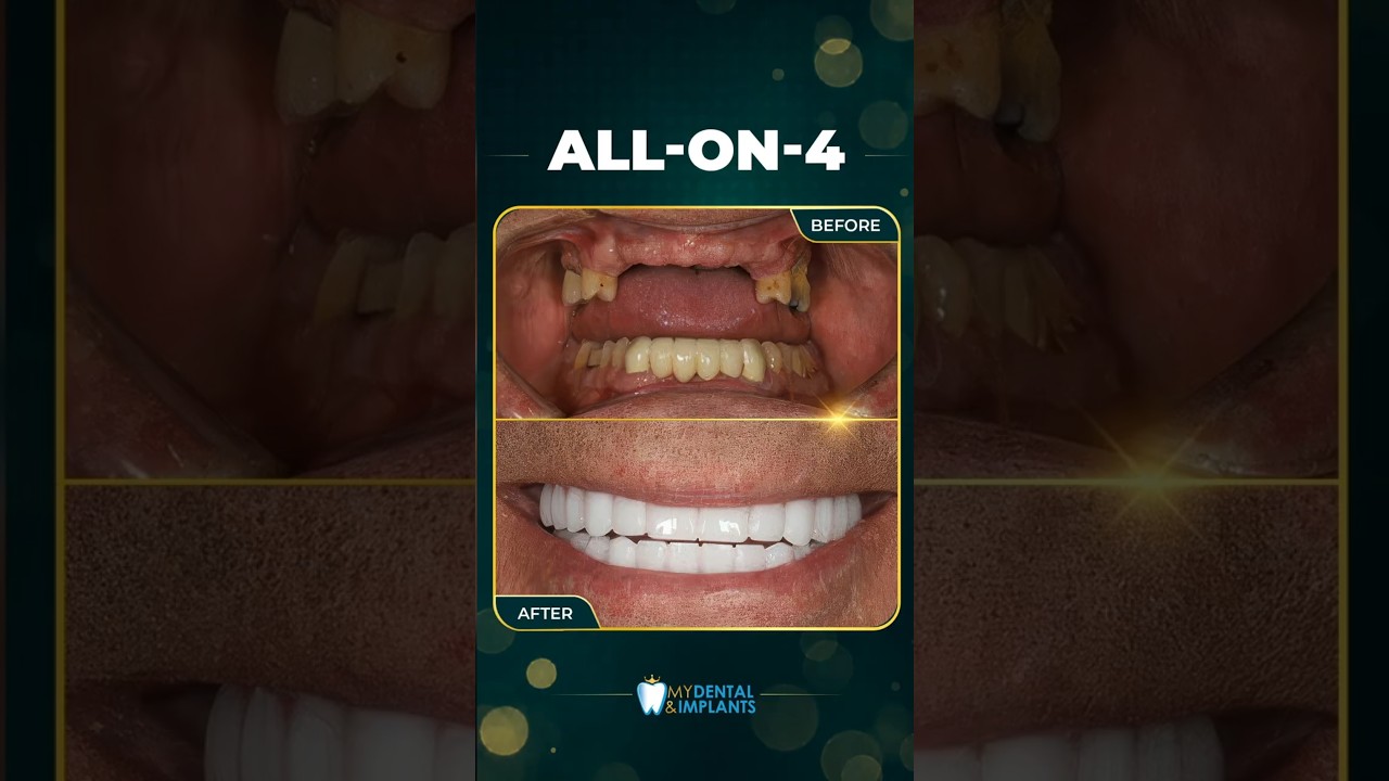All-On-4 Dental Implants Transformation for Glendale Patients | Full Smile Makeover