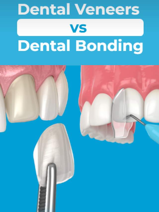 Dental Veneers vs Dental Bonding cover