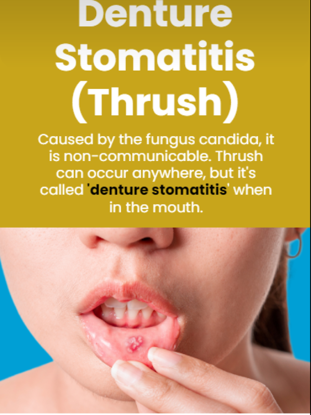 Denture Stomatitis (Thrush)