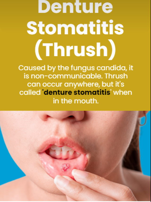 Denture Stomatitis (Thrush) Cover