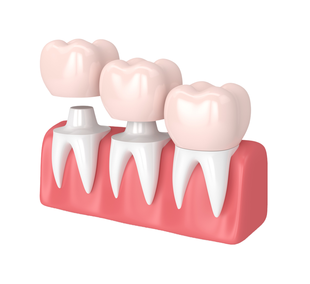 Dental crowns slider 2