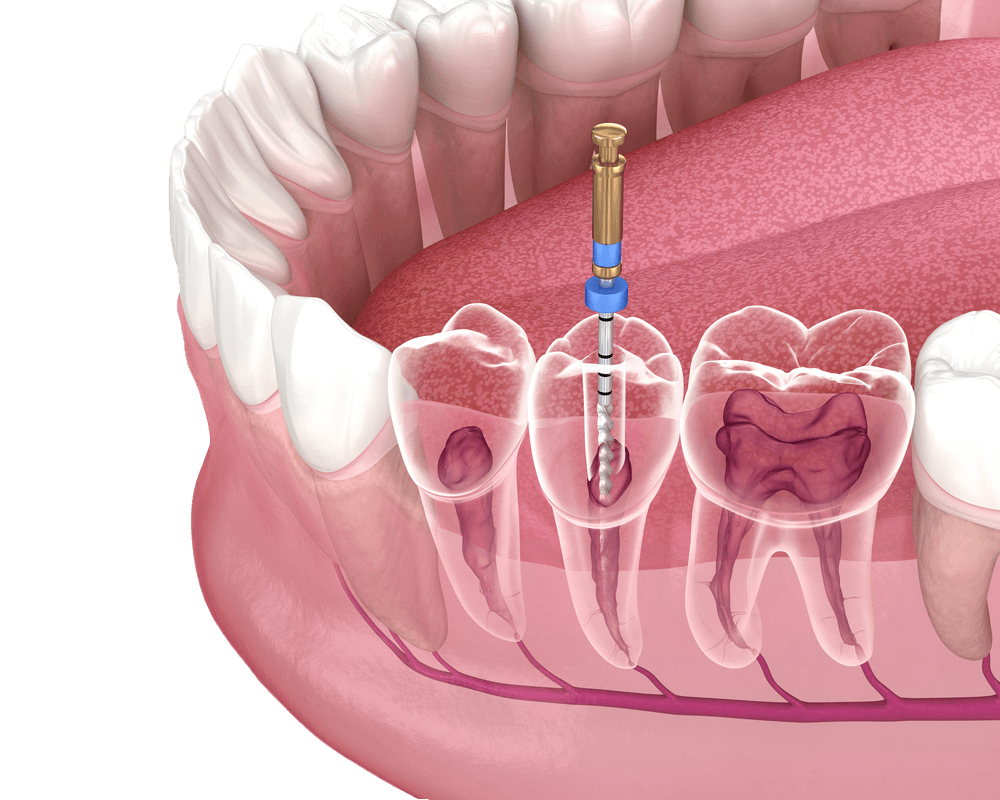 Root canal treatment can save your natural teeth from extraction. slider 1