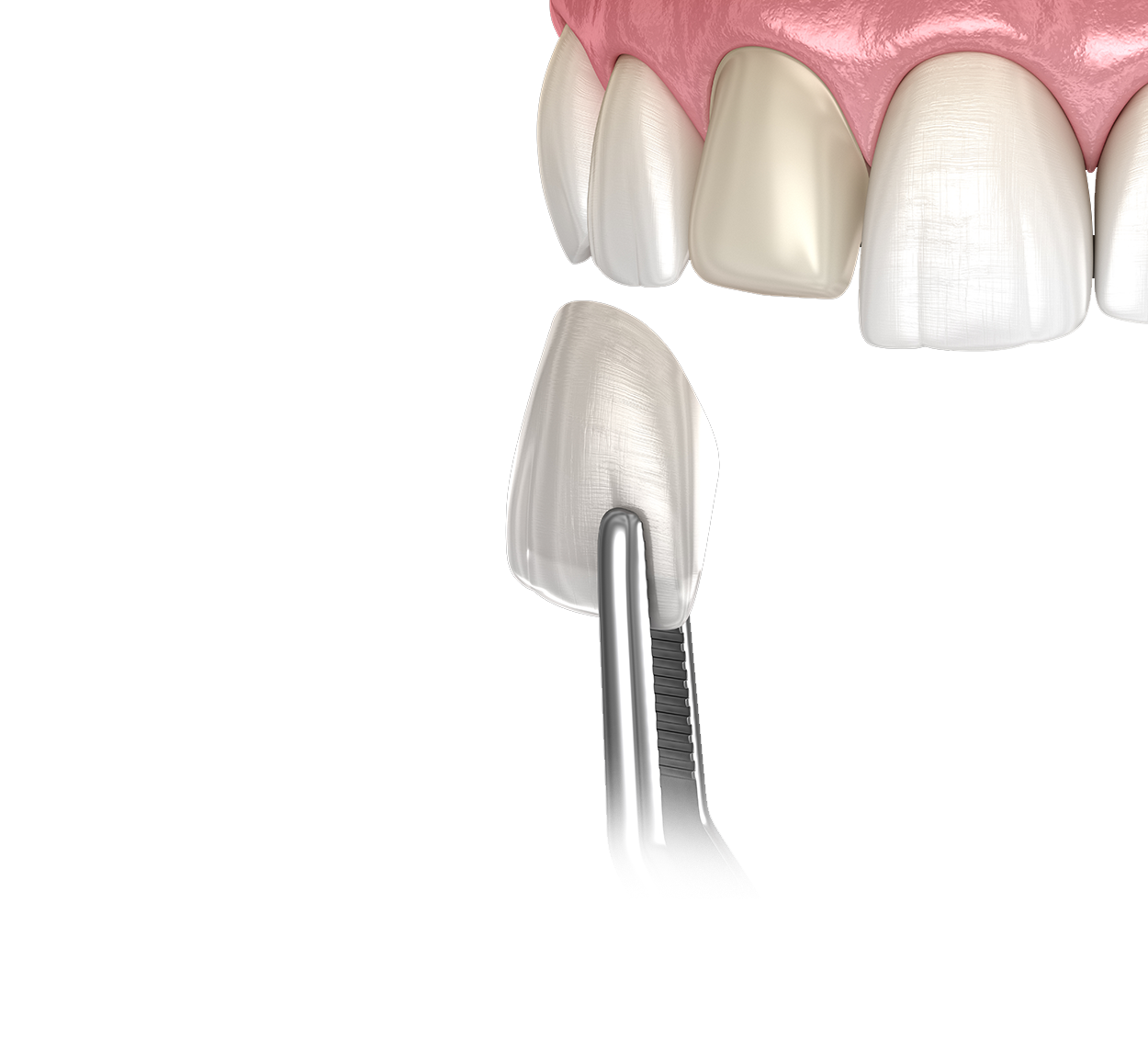 Dental Veneers vs Dental Bonding slider 1