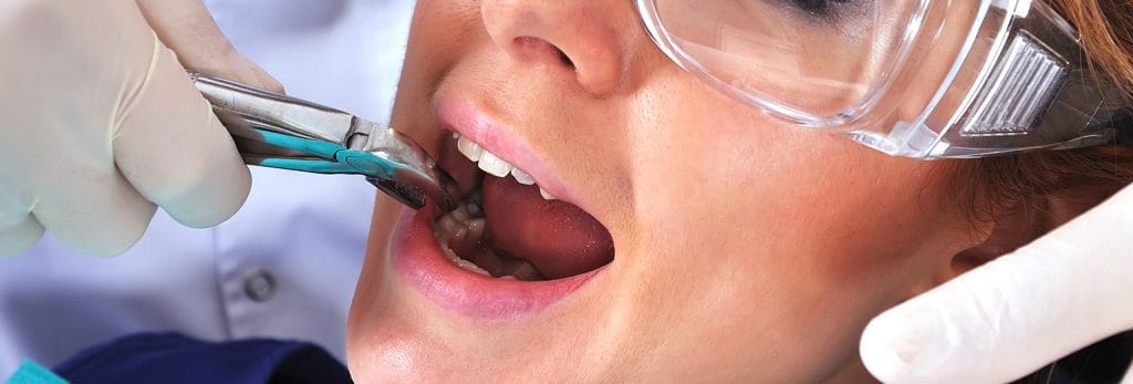 Lady having a tooth extraction