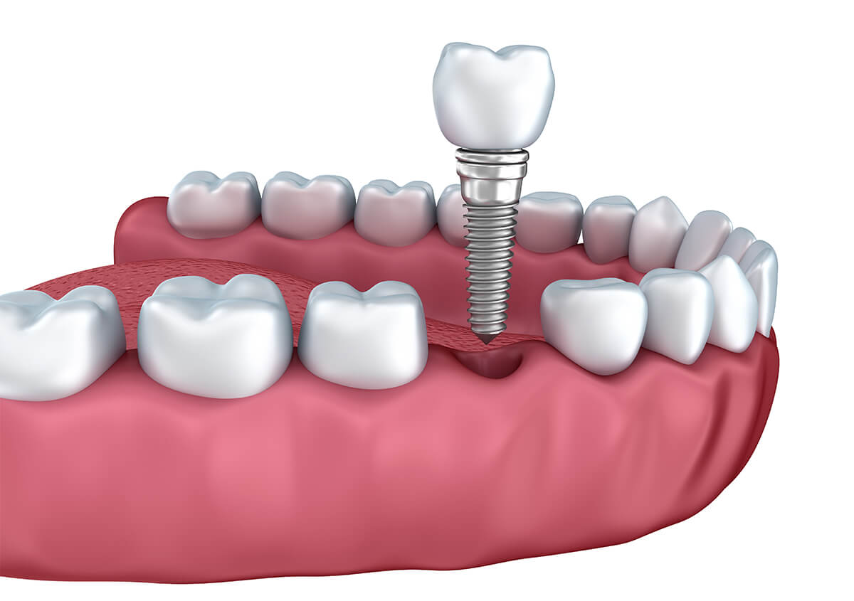 Teeth Implants Dentist in Glendale AZ Area