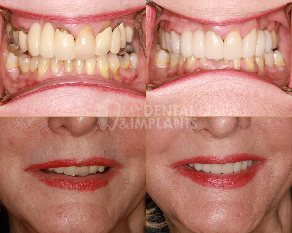 Cosmetic - Before & After Results