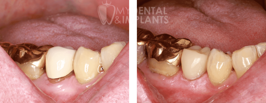 Crowns - Before & After Results