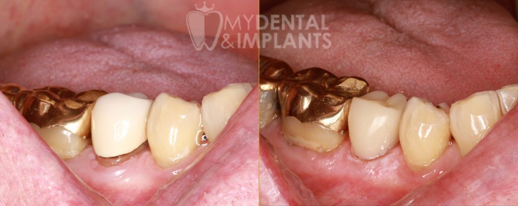 Crowns - Before & After Results