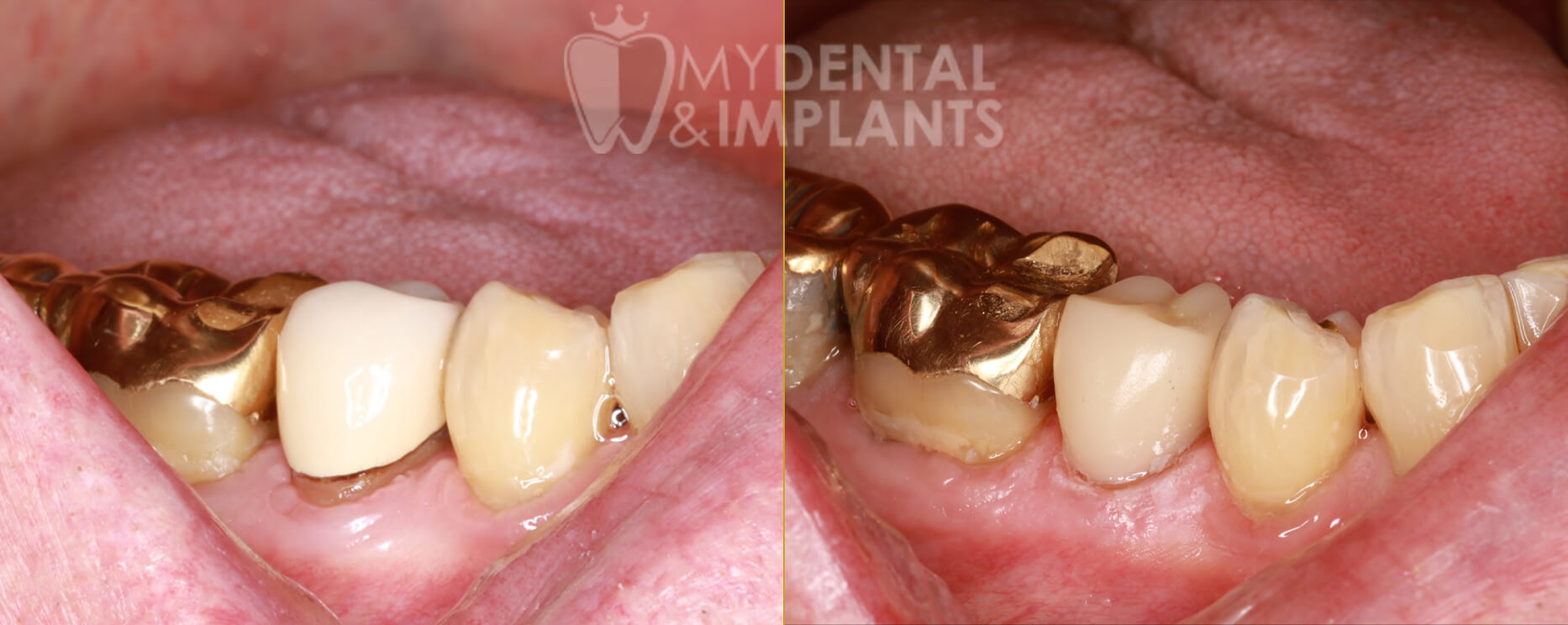 Full Gold Crown Dental Full Gold Crown Dental