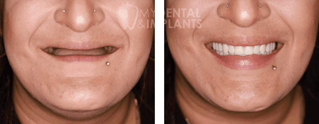 Dentures - Before & After Results 2