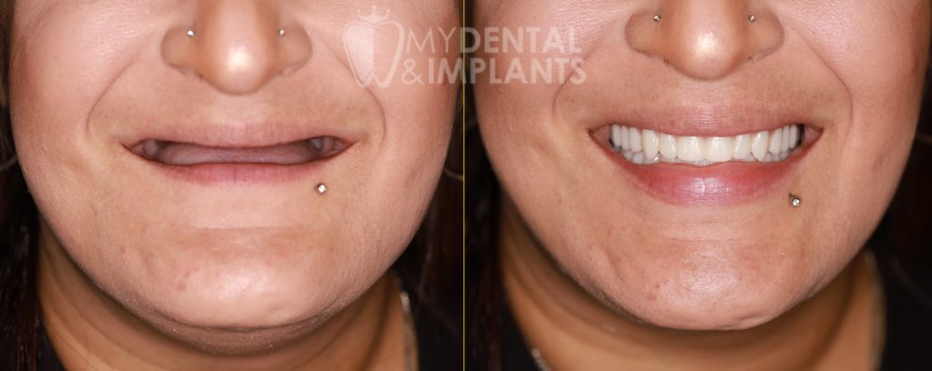 Dentures - Before & After Results 2