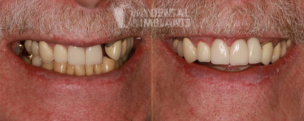 Implants - Before & After Results