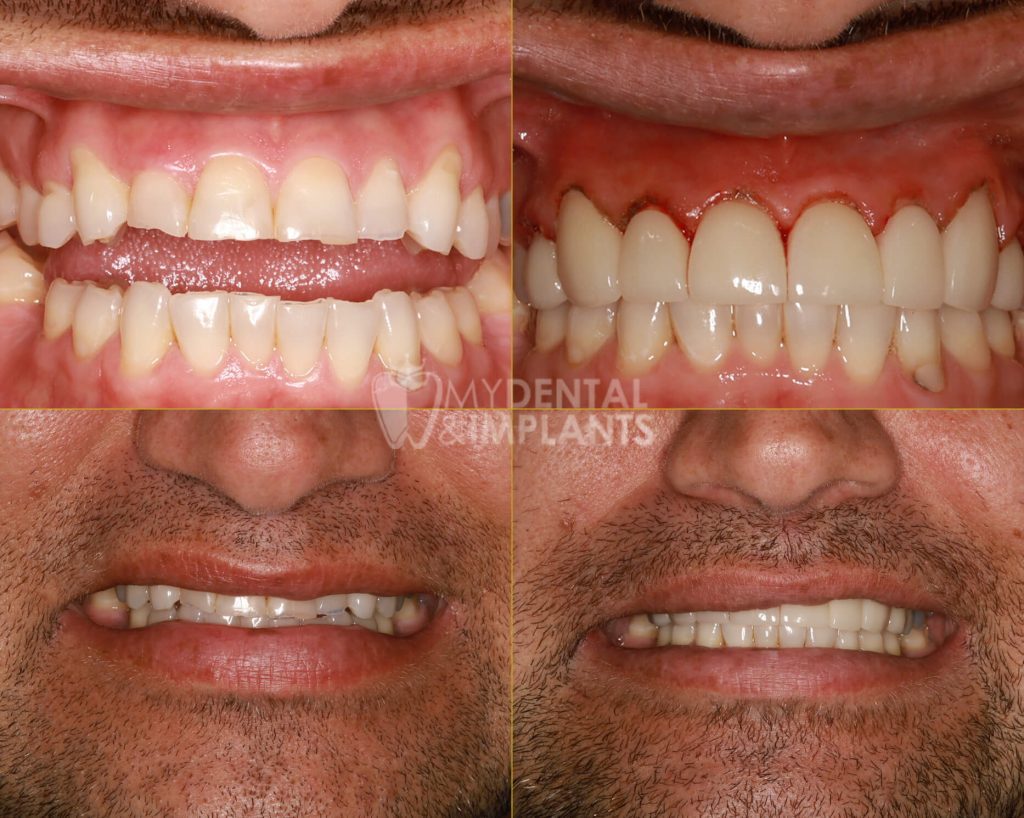 Veneers - Before & After Results