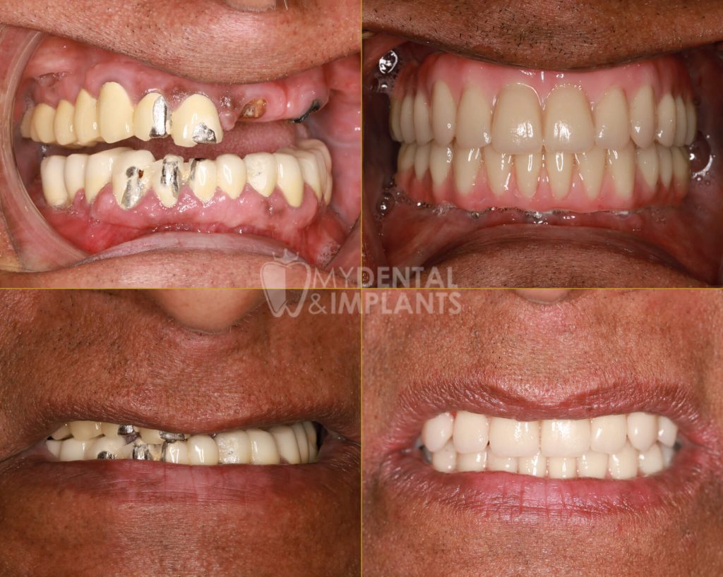 All-On-X Implant Dentures - Before & After Results 1