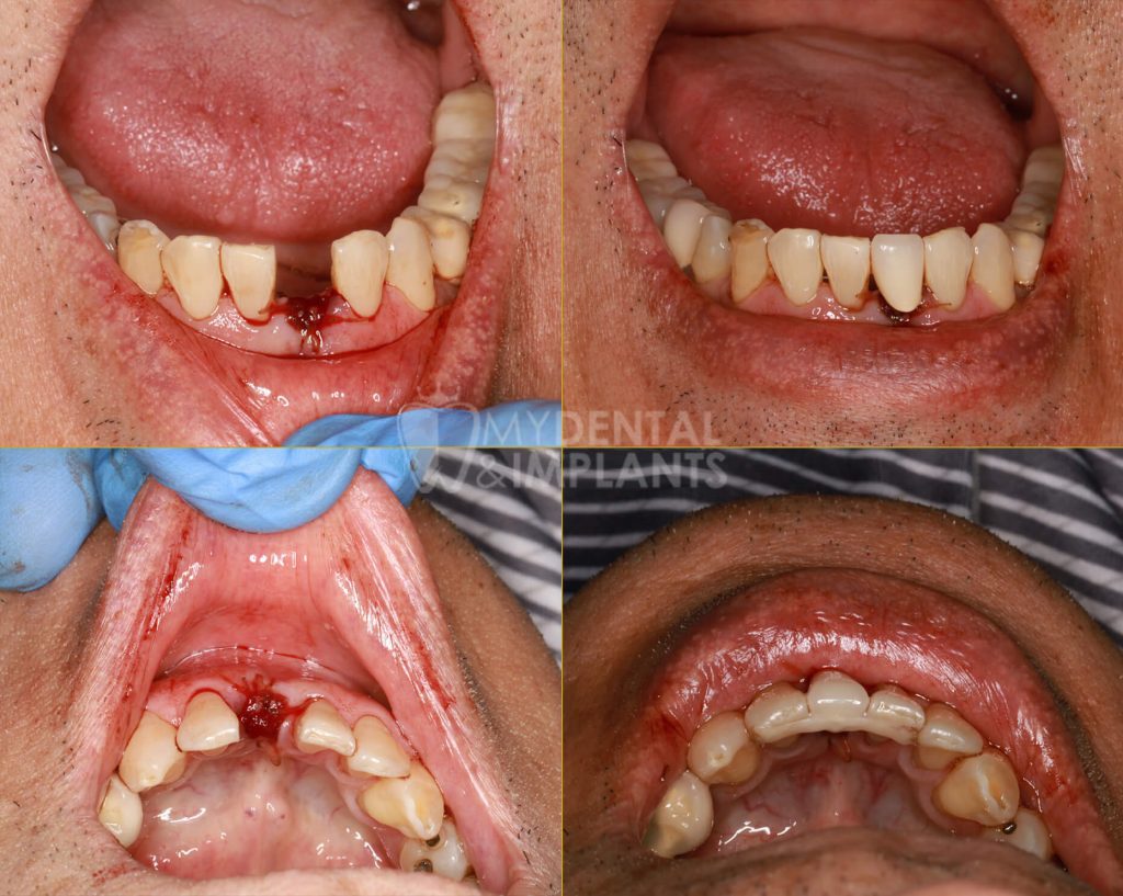 Maryland Bridge - Before & After Results