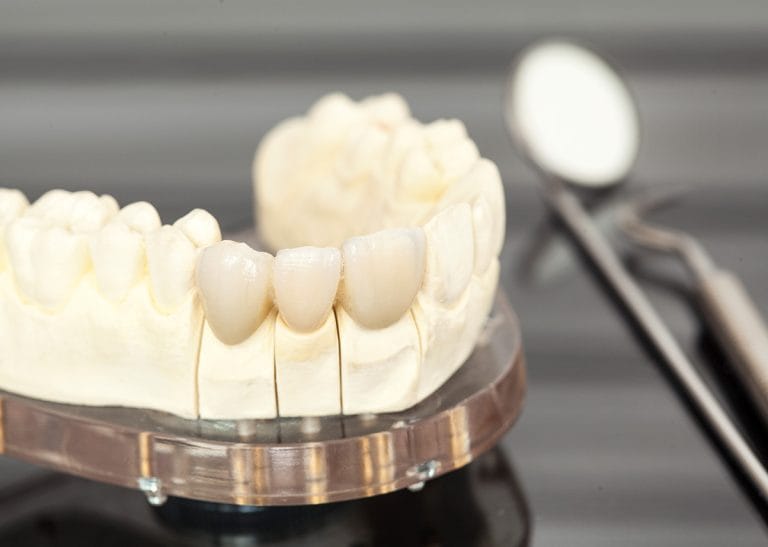 Can Dental Crowns be Used for Cosmetic Dental Purposes in Glendale AZ Area