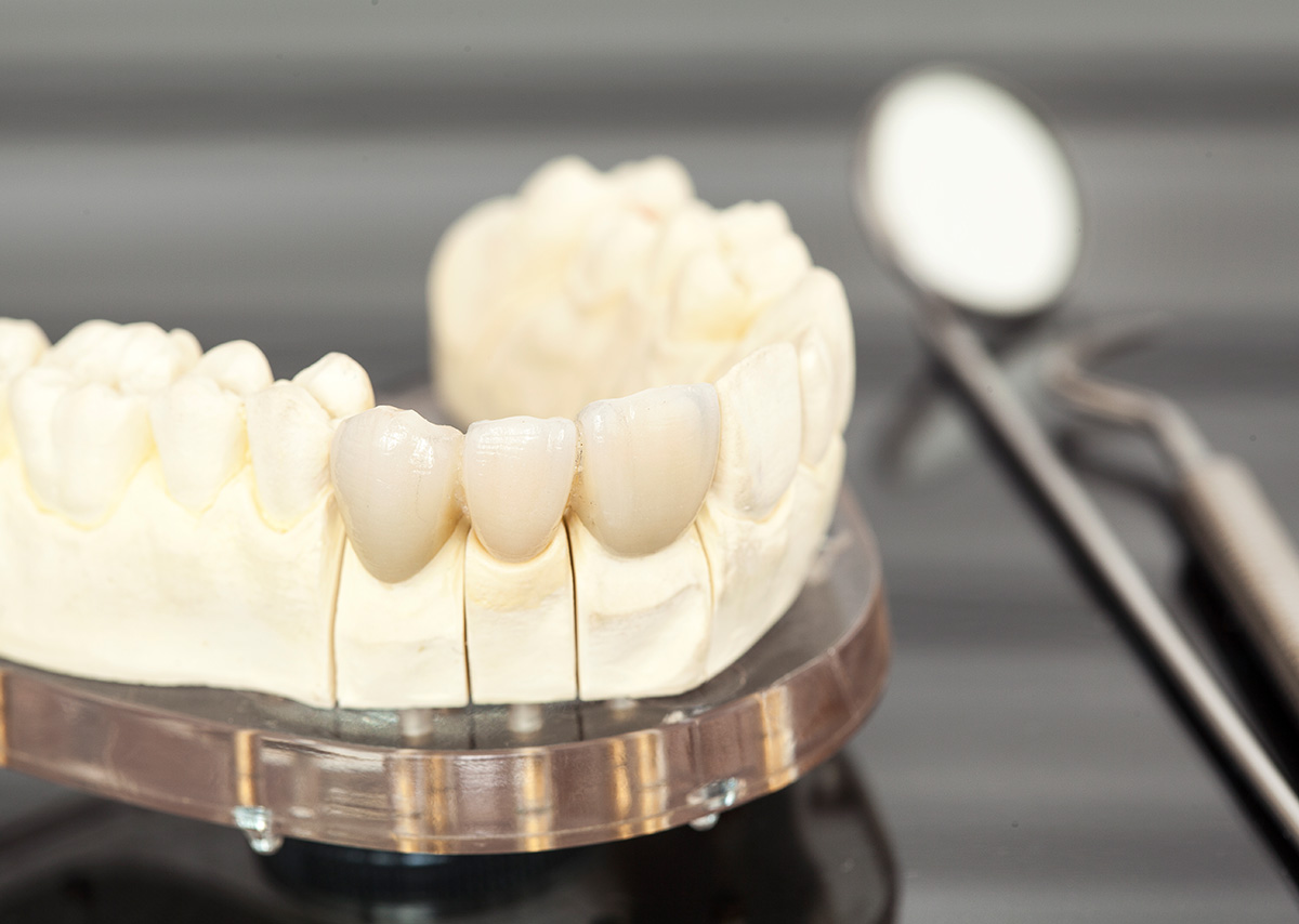 Can Dental Crowns be Used for Cosmetic Dental Purposes in Glendale AZ Area