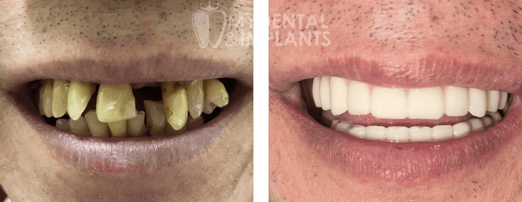 All-On-X Implant Dentures - Before & After Results 2