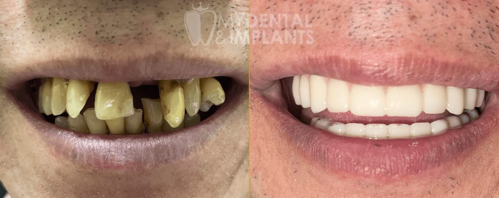 All-On-X Implant Dentures - Before & After Results 2
