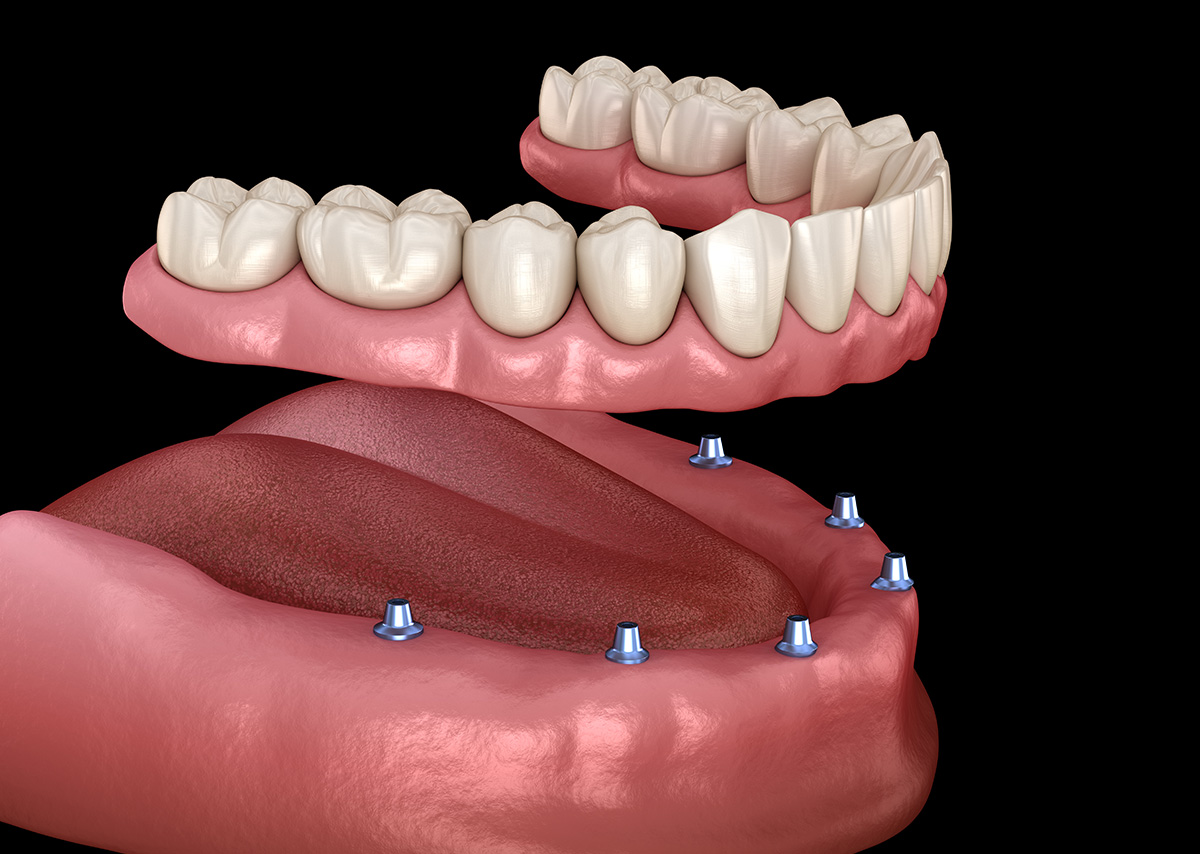 Implant Supported Dentures Are a Step Above the Competition. Find out why in Glendale AZ Area