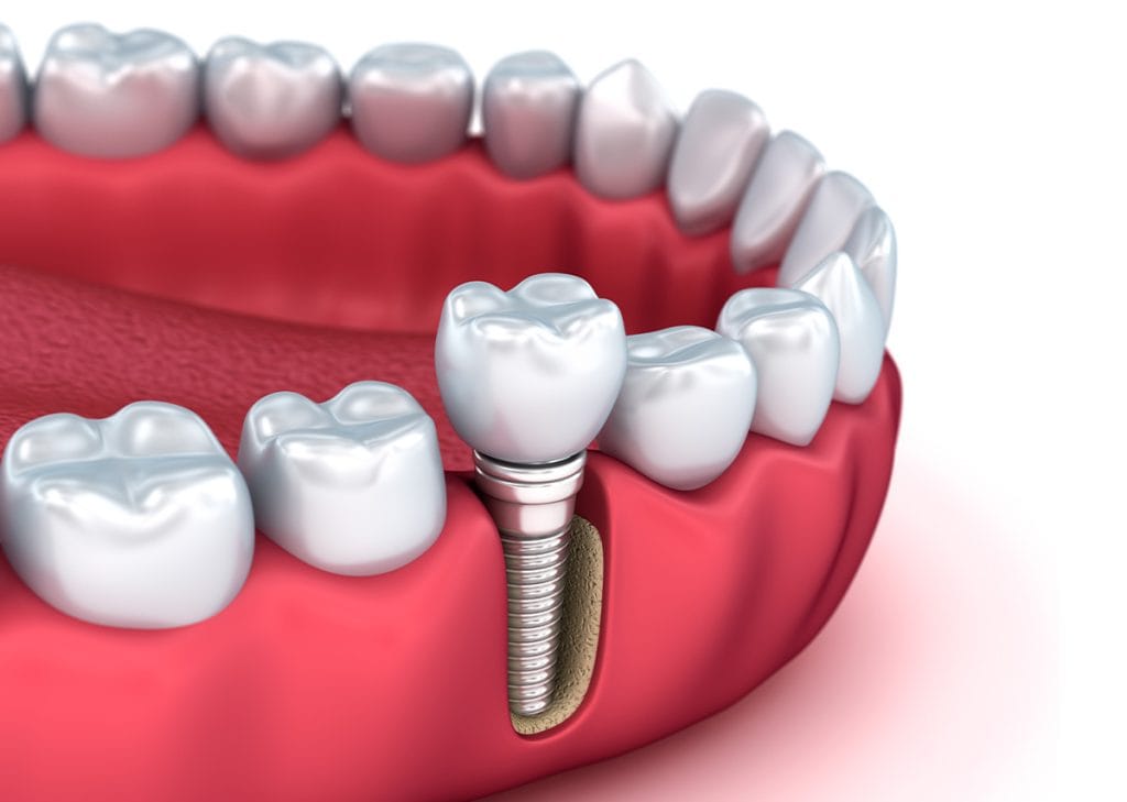 Implant Supported Dentures Are a Step Above the Competition. Find out why in Glendale AZ Area