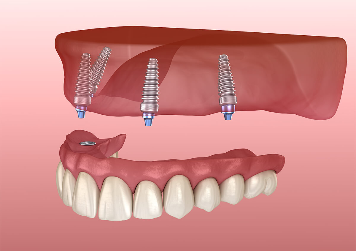 Full Upper Implant Denture in Glendale AZ Area