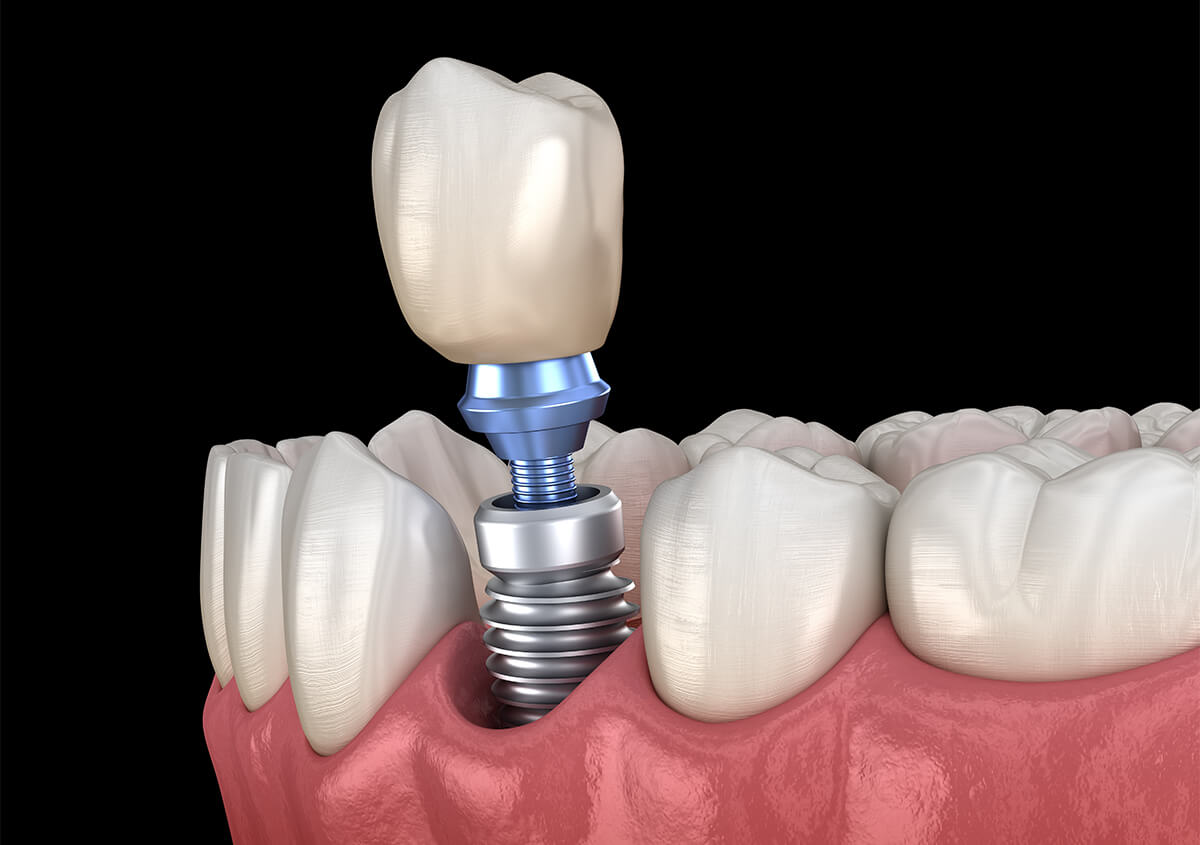 Tooth Implant Process in Glendale AZ Area