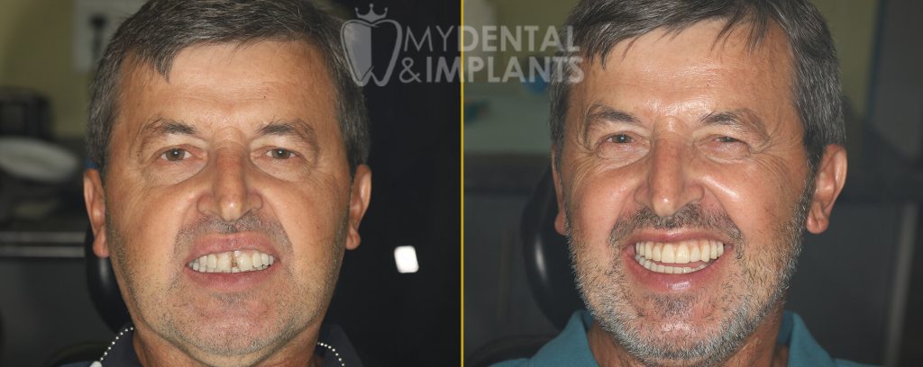 Dental Implants Before and After Treatment Images