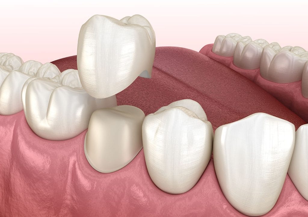 Dentist for Crowns in Glendale AZ Area