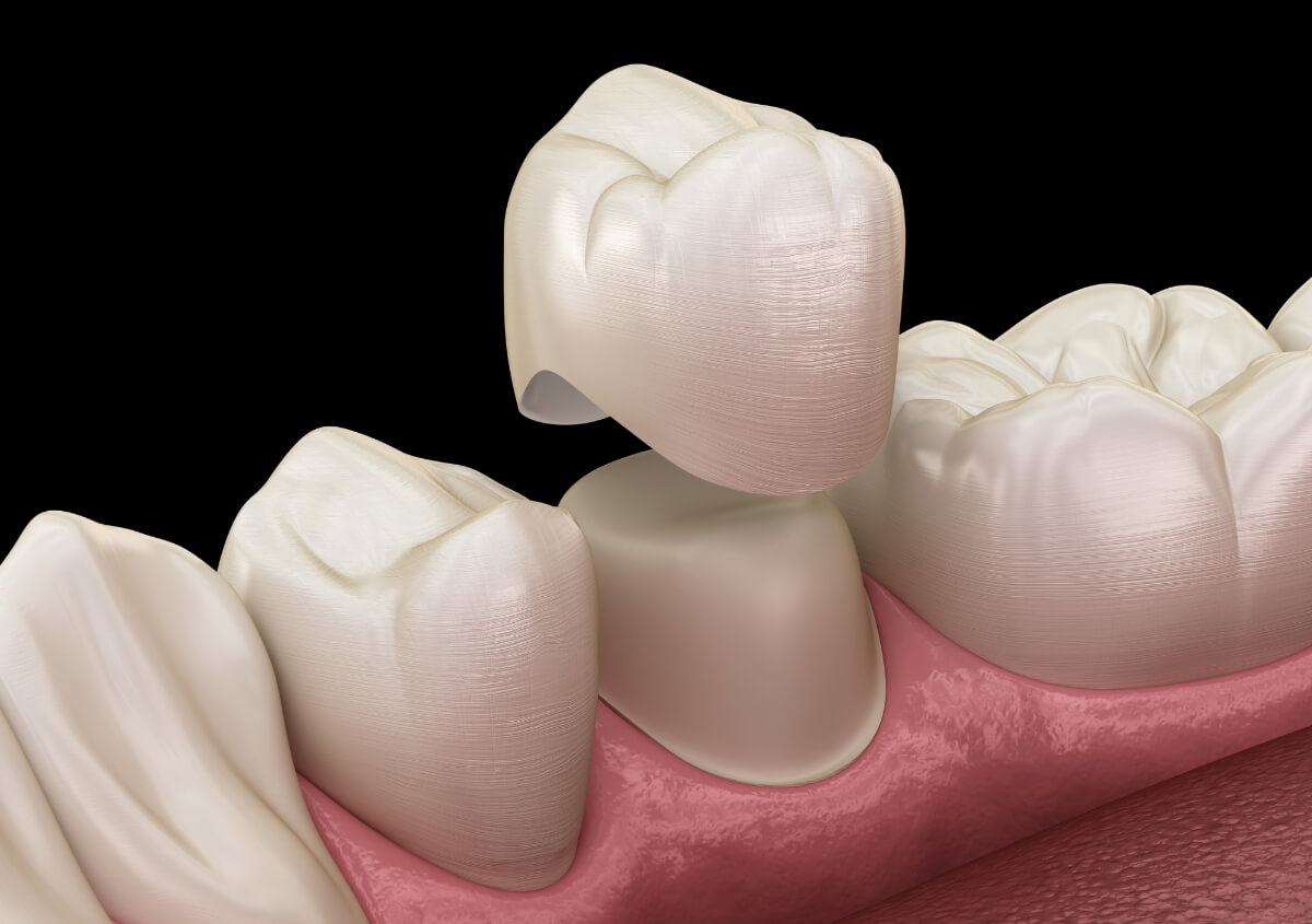 Dental Crowns for Broken Teeth in Glendale AZ area