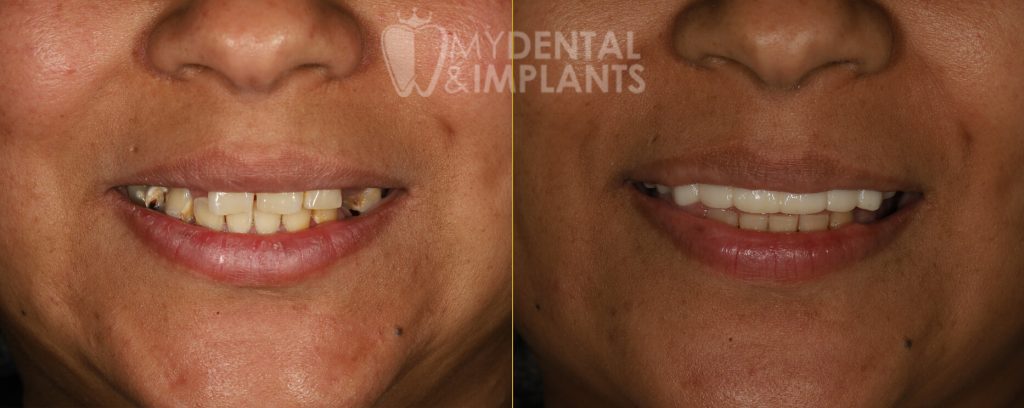 Dental Implants Before and After Treatment Images