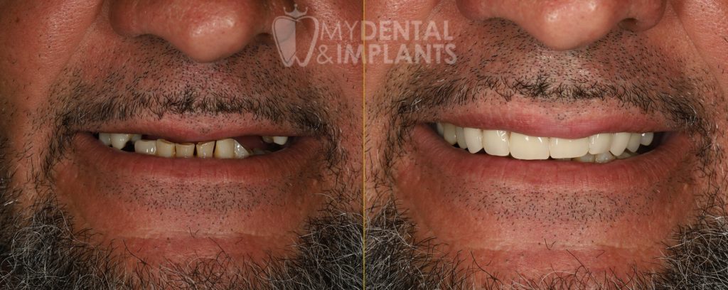 Dental Implants Before and After Image - 4
