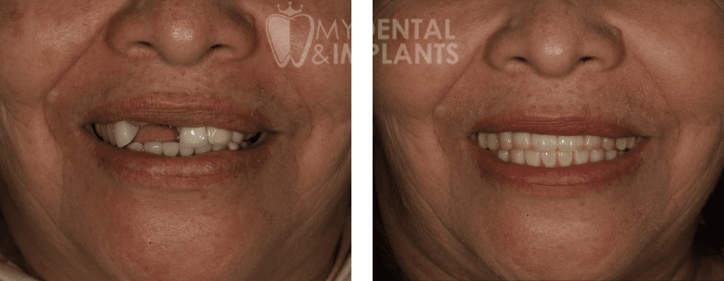 Dental Implants Before and After Image - 5