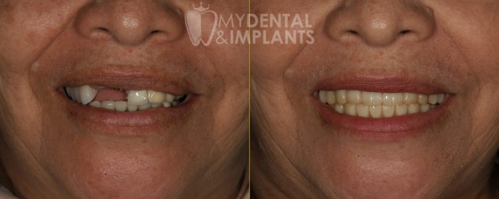Dental Implants Before and After Image - 5