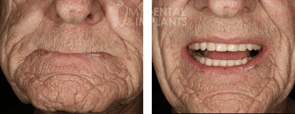 Dentures Before and After Image - 3