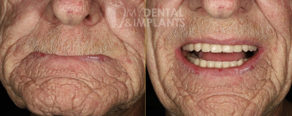 Dentures Before and After Image - 3