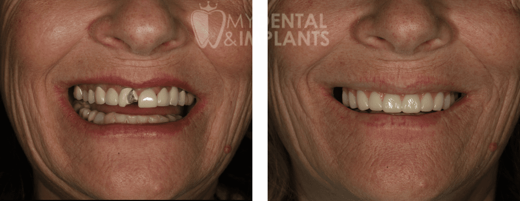 Veneers Before and After Image - 2