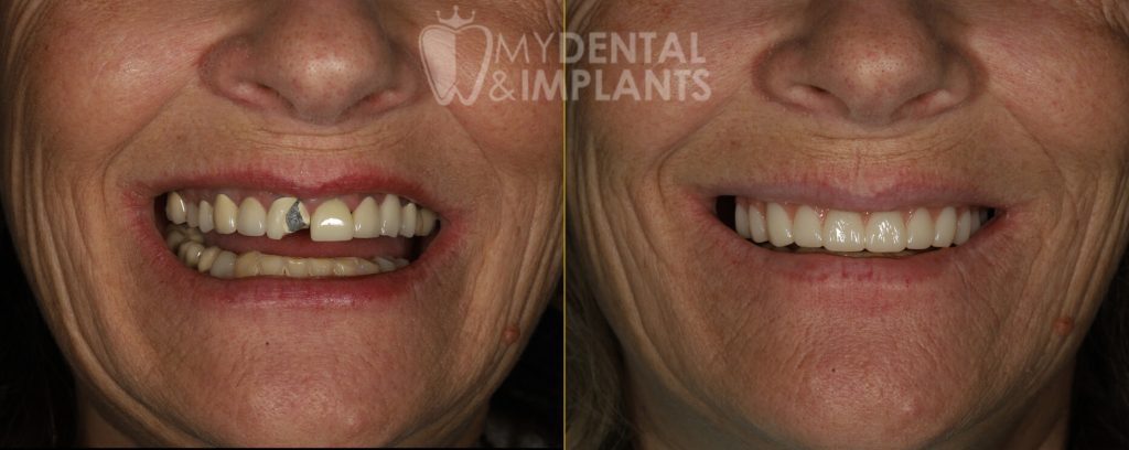 Veneers Before and After Image - 2