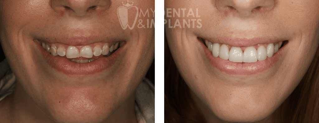 Veneers Before and After Image - 3