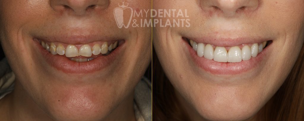 Veneers Before and After Image - 3