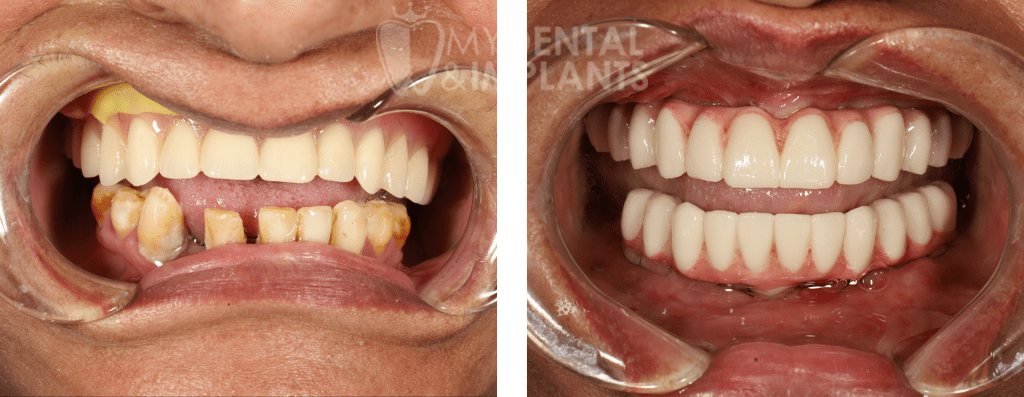 Veneers Before and After Image - 4