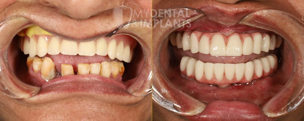 Veneers Before and After Image - 4
