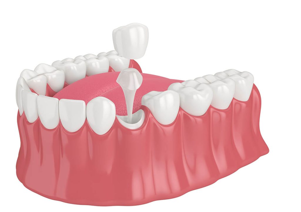 Dental Crown Care in Glendale AZ Area