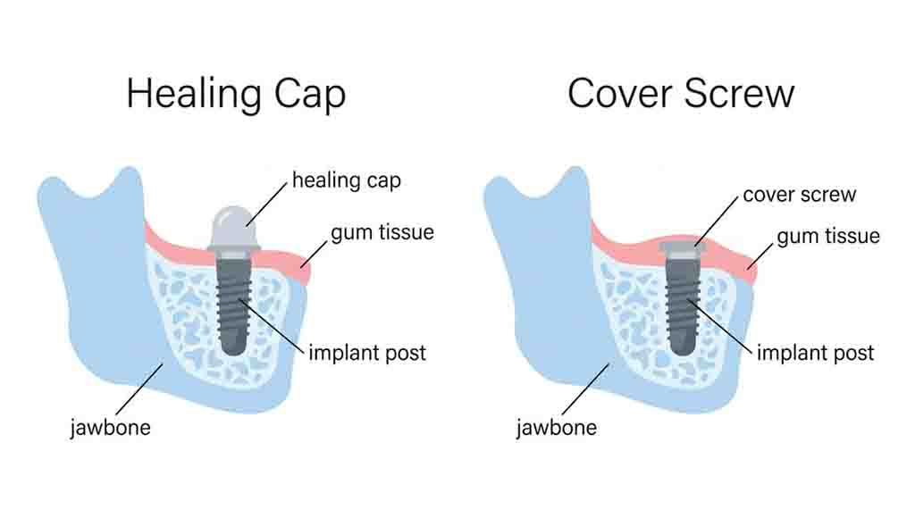 Healing Cap vs. Cover Screw