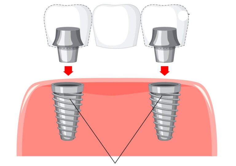 What Are Healing Caps in Dental Implants