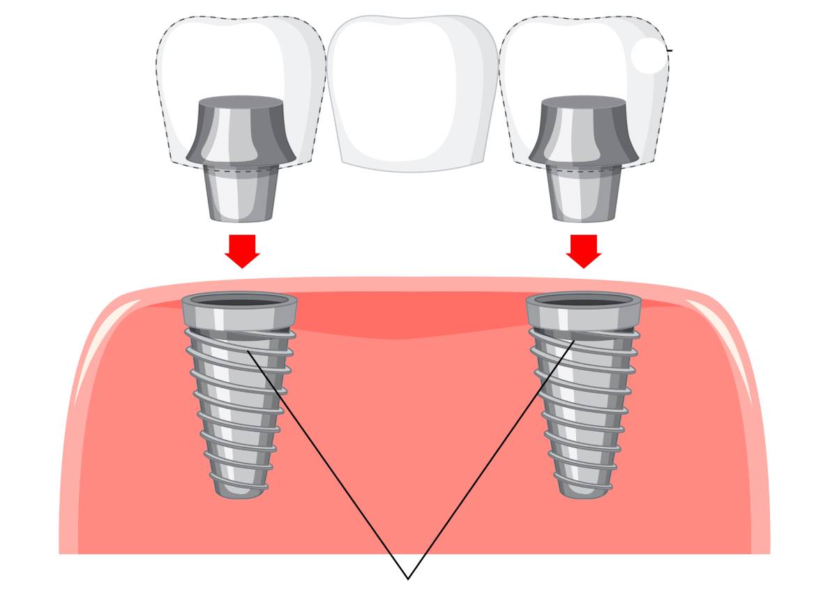 What Are Healing Caps in Dental Implants