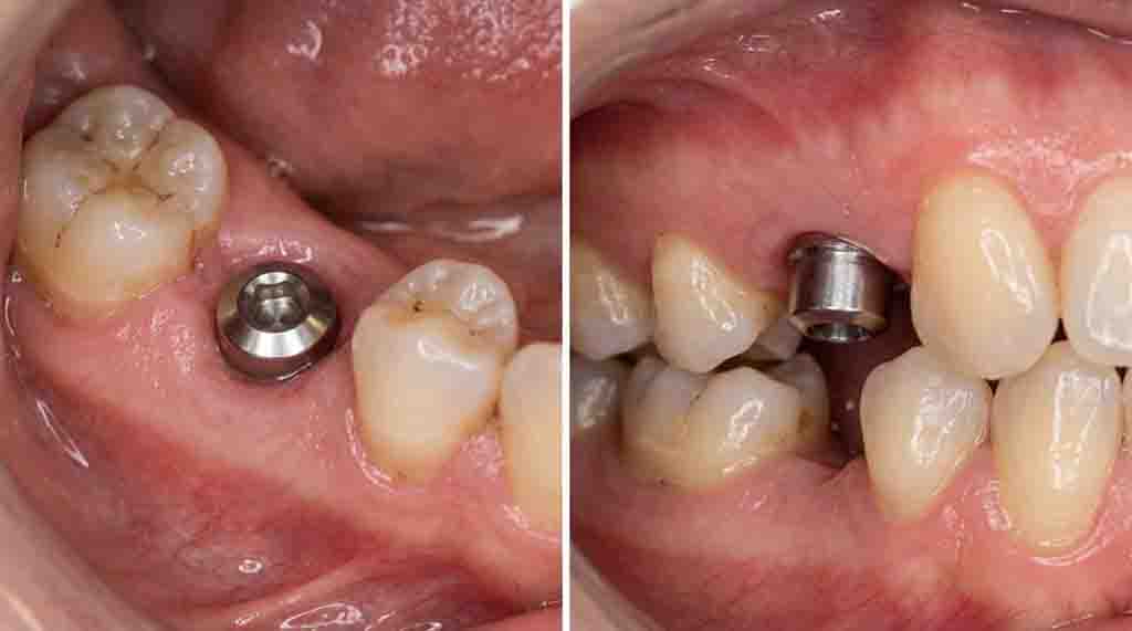 dental implant healing cap pictures