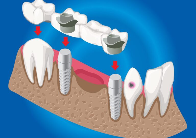 Dental Implant vs Bridge: Which Option Lasts Longer