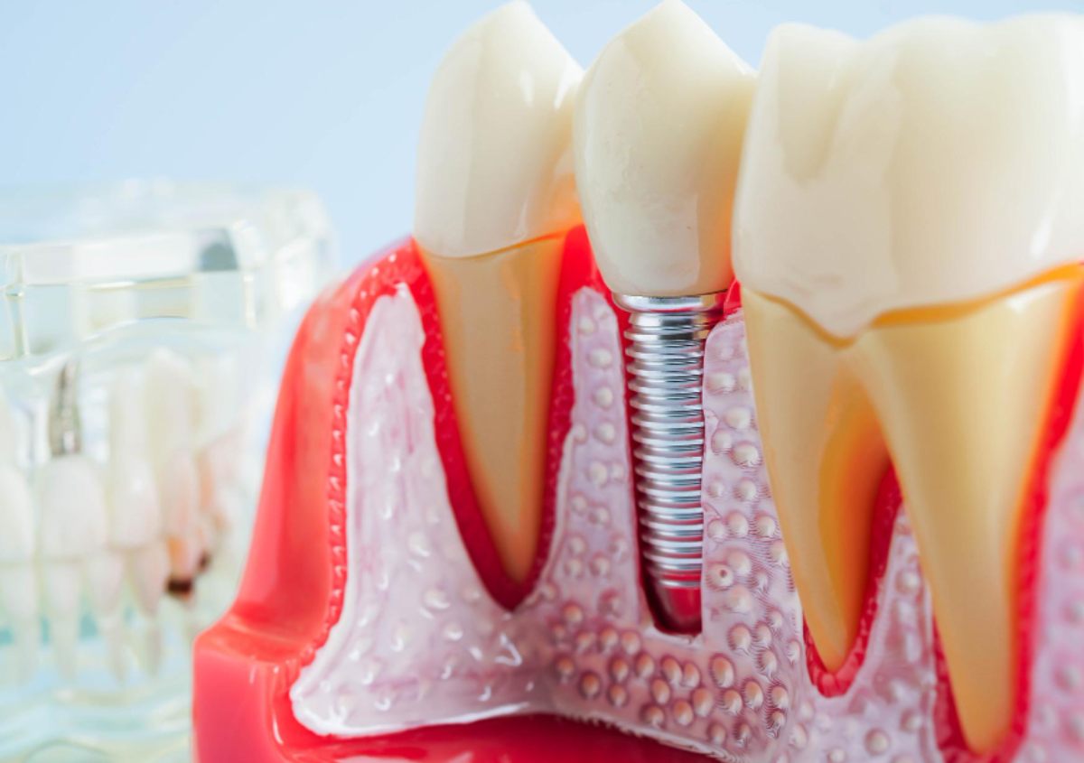 Can You Get Dental Implants with Bone Loss?