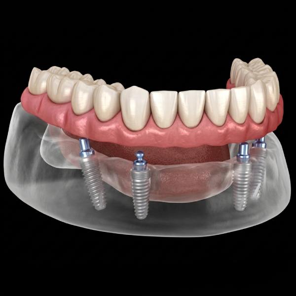 Replace Missing Teeth with All on 4 Dental Implants
